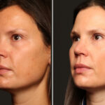 Cosmetic Injectables Before and After Photos in Cincinnati, OH, Patient 16198