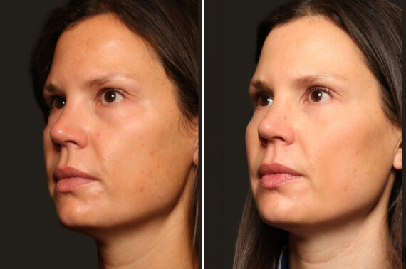Cosmetic Injectables Before and After Photos in Cincinnati, OH, Patient 16198