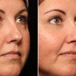 Cosmetic Injectables Before and After Photos in Cincinnati, OH, Patient 16201