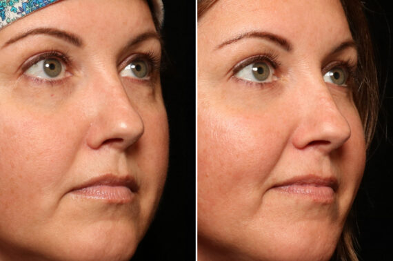 Cosmetic Injectables Before and After Photos in Cincinnati, OH, Patient 16201