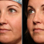 Cosmetic Injectables Before and After Photos in Cincinnati, OH, Patient 16201
