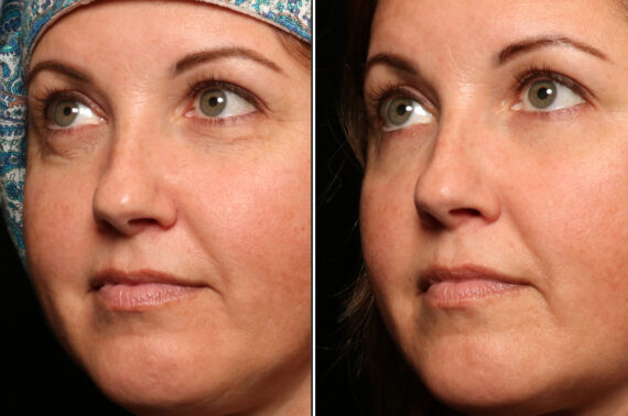 Cosmetic Injectables Before and After Photos in Cincinnati, OH, Patient 16201