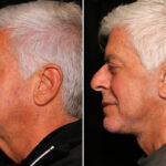 Male Plastic Surgery Before and After Photos in Cincinnati, OH, Patient 16439