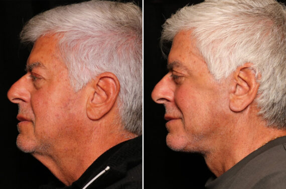 Male Plastic Surgery Before and After Photos in Cincinnati, OH, Patient 16439