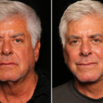Male Plastic Surgery Before and After Photos in Cincinnati, OH, Patient 16439