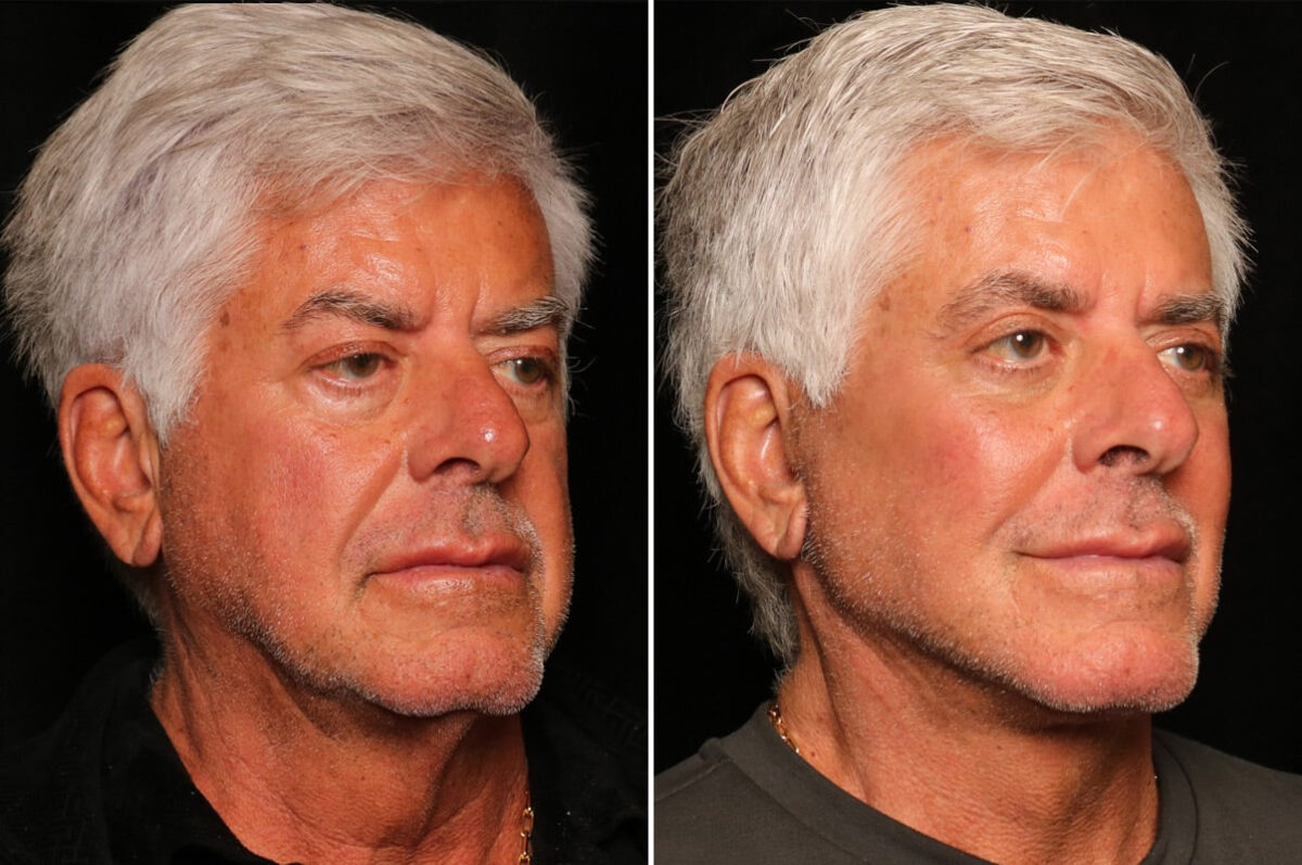 Male Plastic Surgery Before and After Photos in Cincinnati, OH, Patient 16439