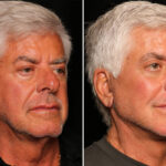 Male Plastic Surgery Before and After Photos in Cincinnati, OH, Patient 16439