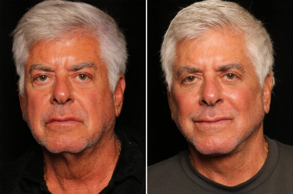 Male Plastic Surgery Before and After Photos in Cincinnati, OH, Patient 16439