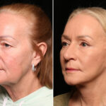 Blepharoplasty Before and After Photos in Cincinnati, OH, Patient 14480