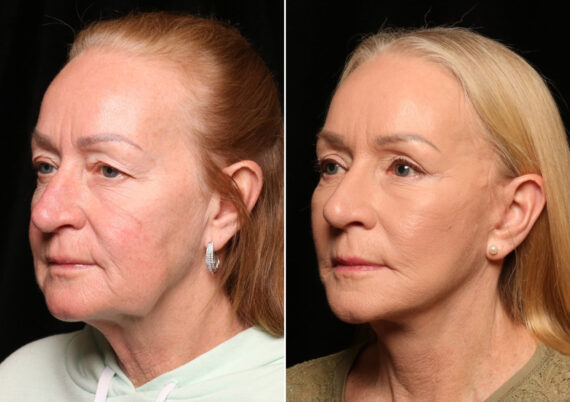 Facial Liposuction Before and After Photos in Cincinnati, OH