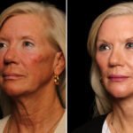 Brow lift Before and After Photos in Cincinnati, OH, Patient 16453
