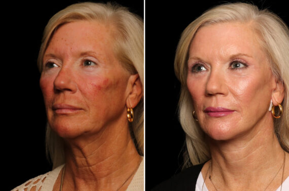 Brow lift Before and After Photos in Cincinnati, OH, Patient 16453