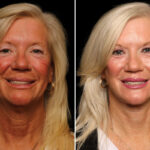 Brow lift Before and After Photos in Cincinnati, OH, Patient 16453