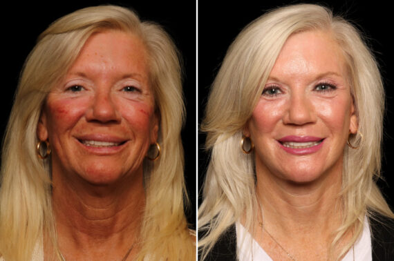 Brow lift Before and After Photos in Cincinnati, OH, Patient 16453