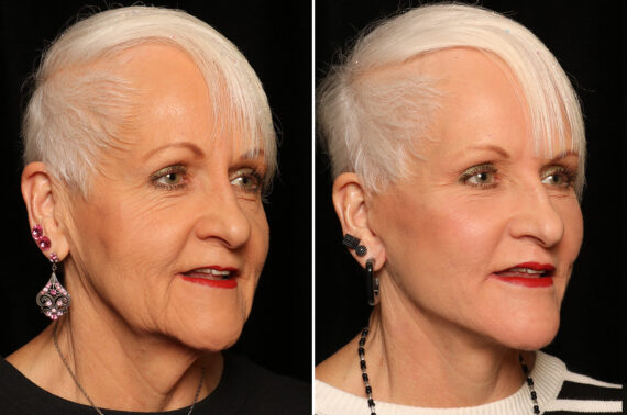 LuxeLift Before and After Photos in Cincinnati, OH, Patient 16961