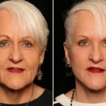 LuxeLift Before and After Photos in Cincinnati, OH, Patient 16961
