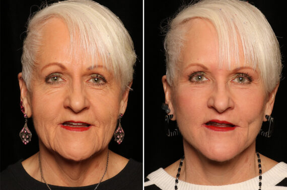 LuxeLift Before and After Photos in Cincinnati, OH, Patient 16961