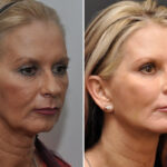 Facial Resurfacing Before and After Photos in Cincinnati, OH, Patient 5888