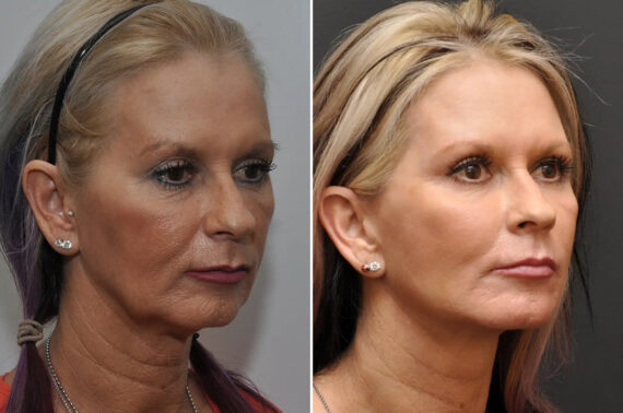 Facial Resurfacing Before and After Photos in Cincinnati, OH, Patient 5888