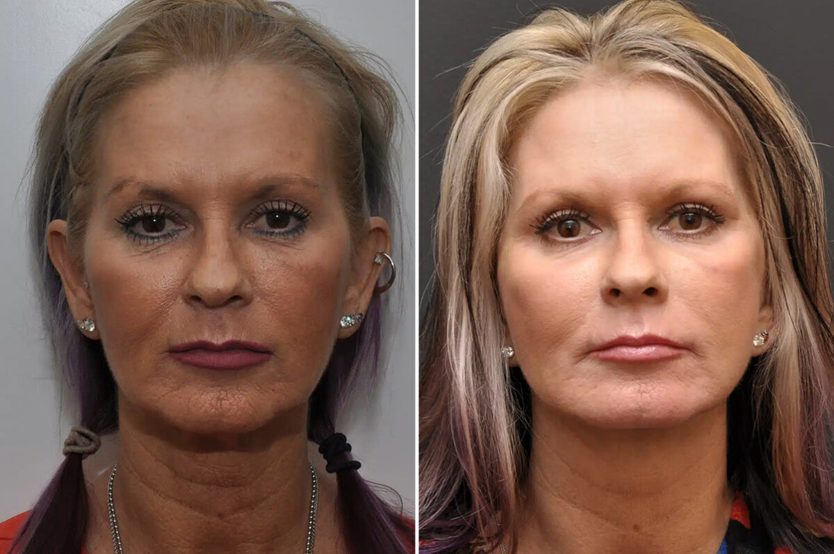 Facial Resurfacing Before and After Photos in Cincinnati, OH, Patient 5888