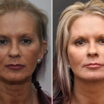 Facial Resurfacing Before and After Photos in Cincinnati, OH, Patient 5888