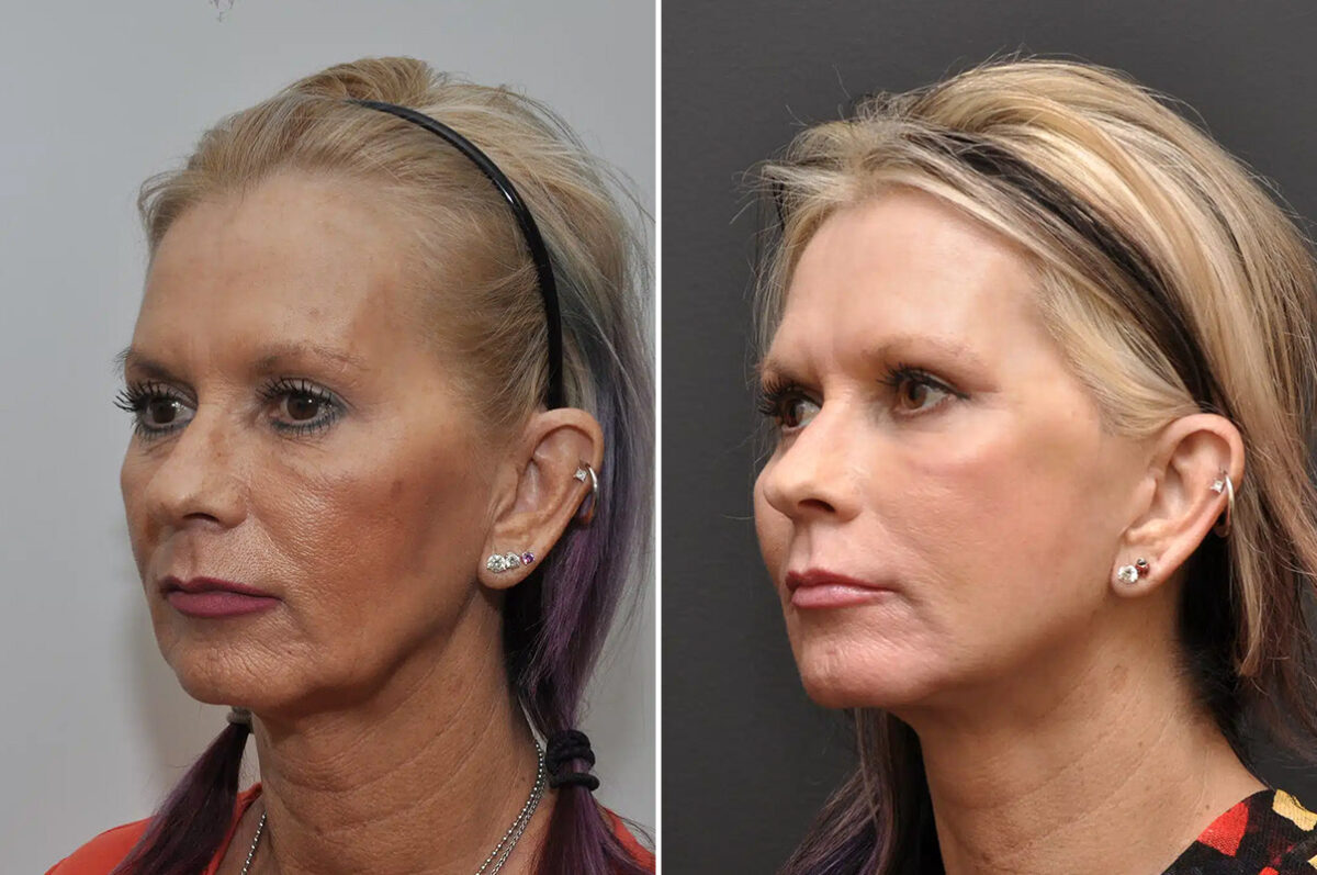 Facial Resurfacing Before and After Photos in Cincinnati, OH, Patient 5888
