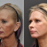 Facial Resurfacing Before and After Photos in Cincinnati, OH, Patient 5888