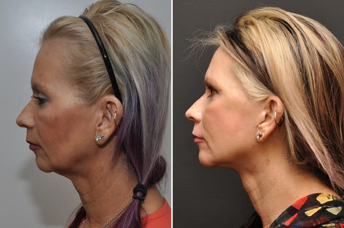 Facial Resurfacing Before and After Photos in Cincinnati, OH, Patient 5888