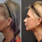 Facial Resurfacing Before and After Photos in Cincinnati, OH, Patient 5888