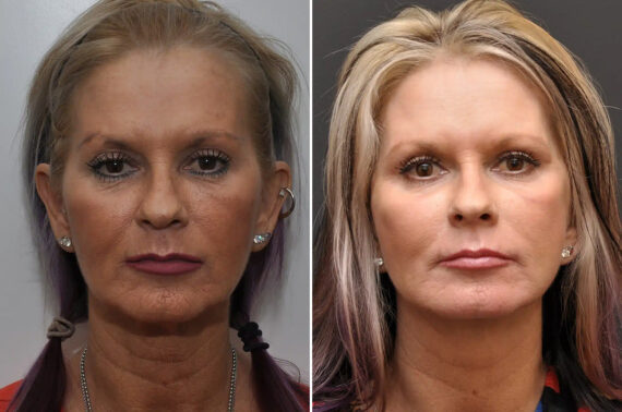 Facial Resurfacing Before and After Photos in Cincinnati, OH, Patient 5888
