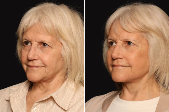 LuxeLift Before and After Photos in Cincinnati, OH, Patient 17884
