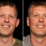 Otoplasty Before and After Photos in Cincinnati, OH, Patient 17892