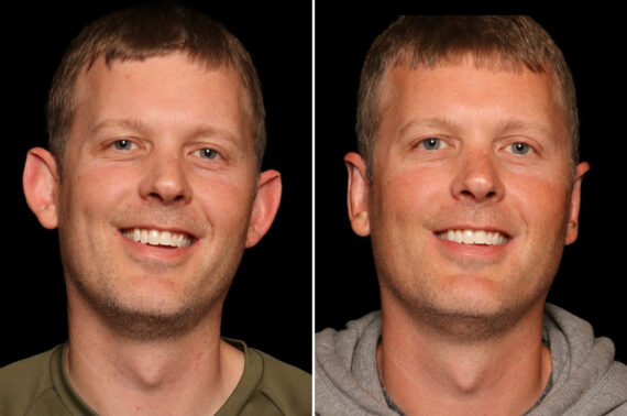 Otoplasty Before and After Photos in Cincinnati, OH, Patient 17892