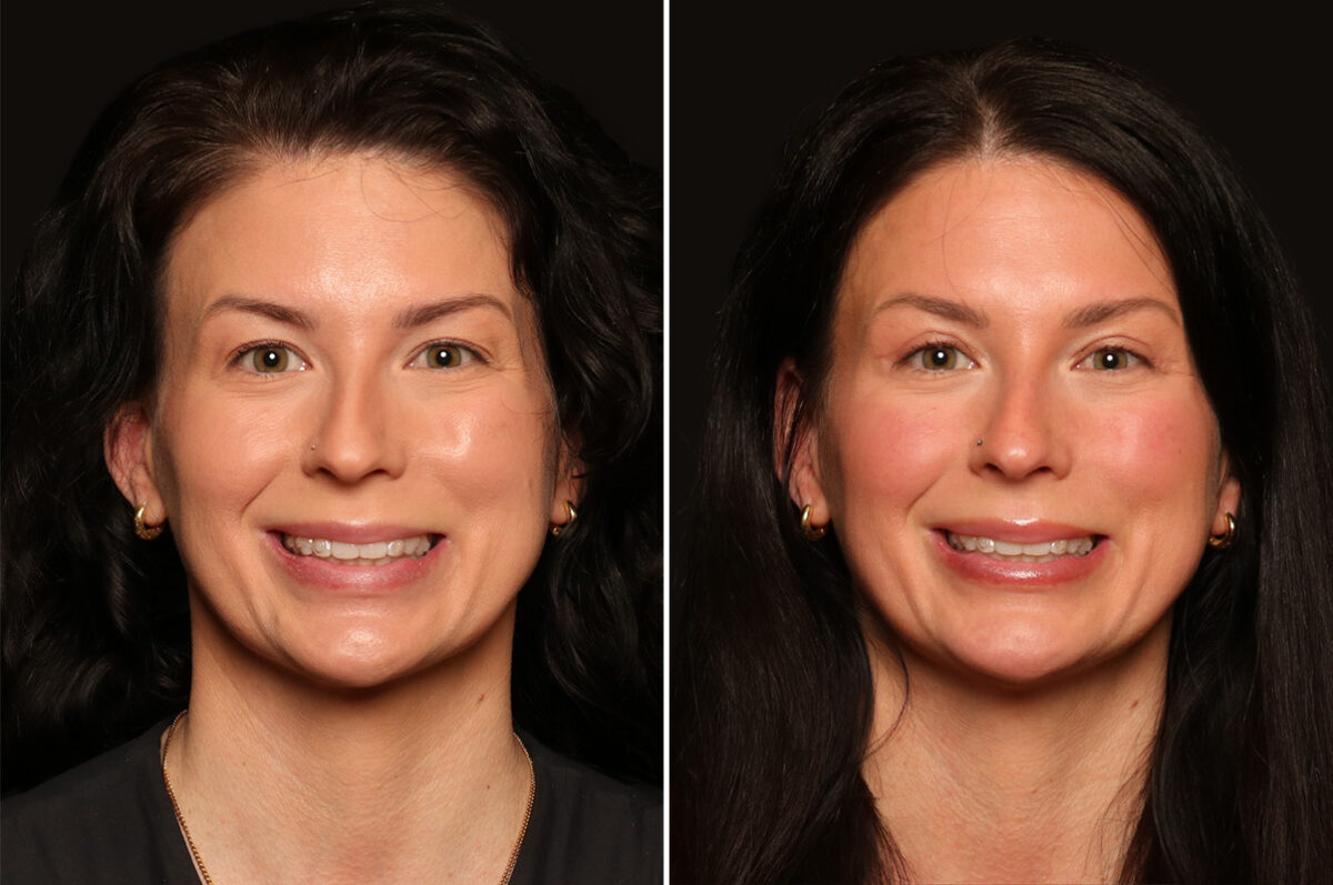 Blepharoplasty Before and After Photos in Cincinnati, OH, Patient 17894