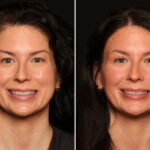 Blepharoplasty Before and After Photos in Cincinnati, OH, Patient 17894