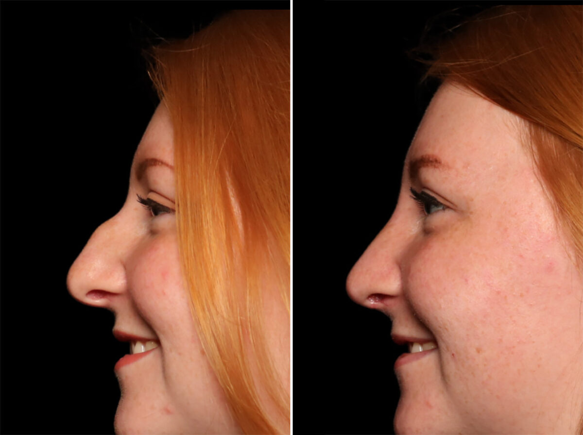 Rhinoplasty (Nose Reshaping) Before and After Photos in , , Patient 18122