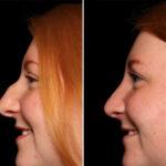Rhinoplasty (Nose Reshaping) Before and After Photos in , , Patient 18122