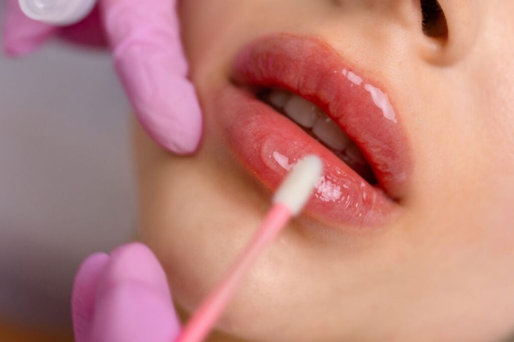 Close-up of lip filler application showing precise injection technique to enhance fullness and prolong lasting results.