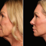 LuxeLift Before and After Photos in Cincinnati, OH, Patient 18459