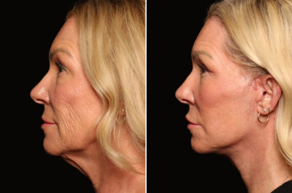 LuxeLift Before and After Photos in Cincinnati, OH, Patient 18459