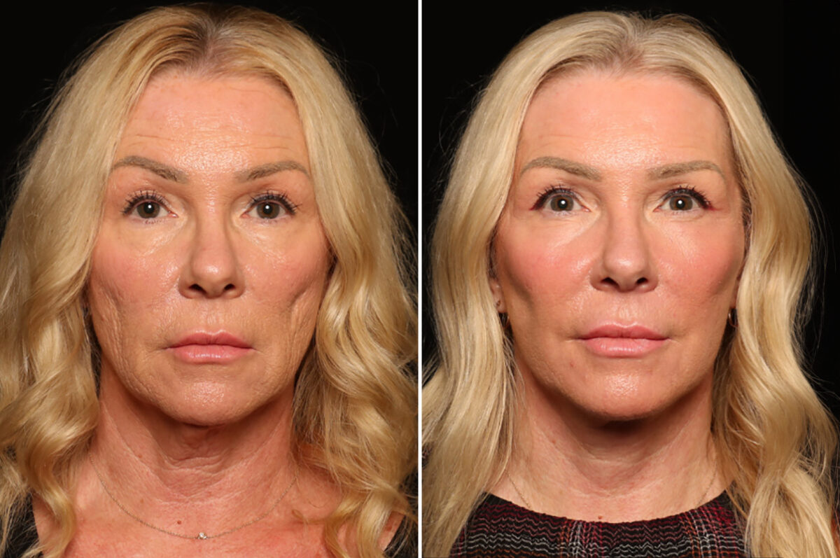 LuxeLift Before and After Photos in Cincinnati, OH, Patient 18459