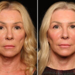 LuxeLift Before and After Photos in Cincinnati, OH, Patient 18459
