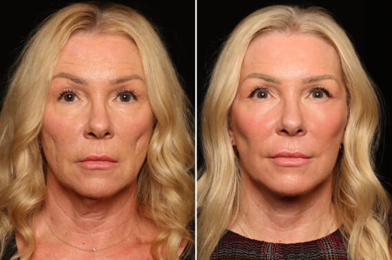 LuxeLift Before and After Photos in Cincinnati, OH, Patient 18459