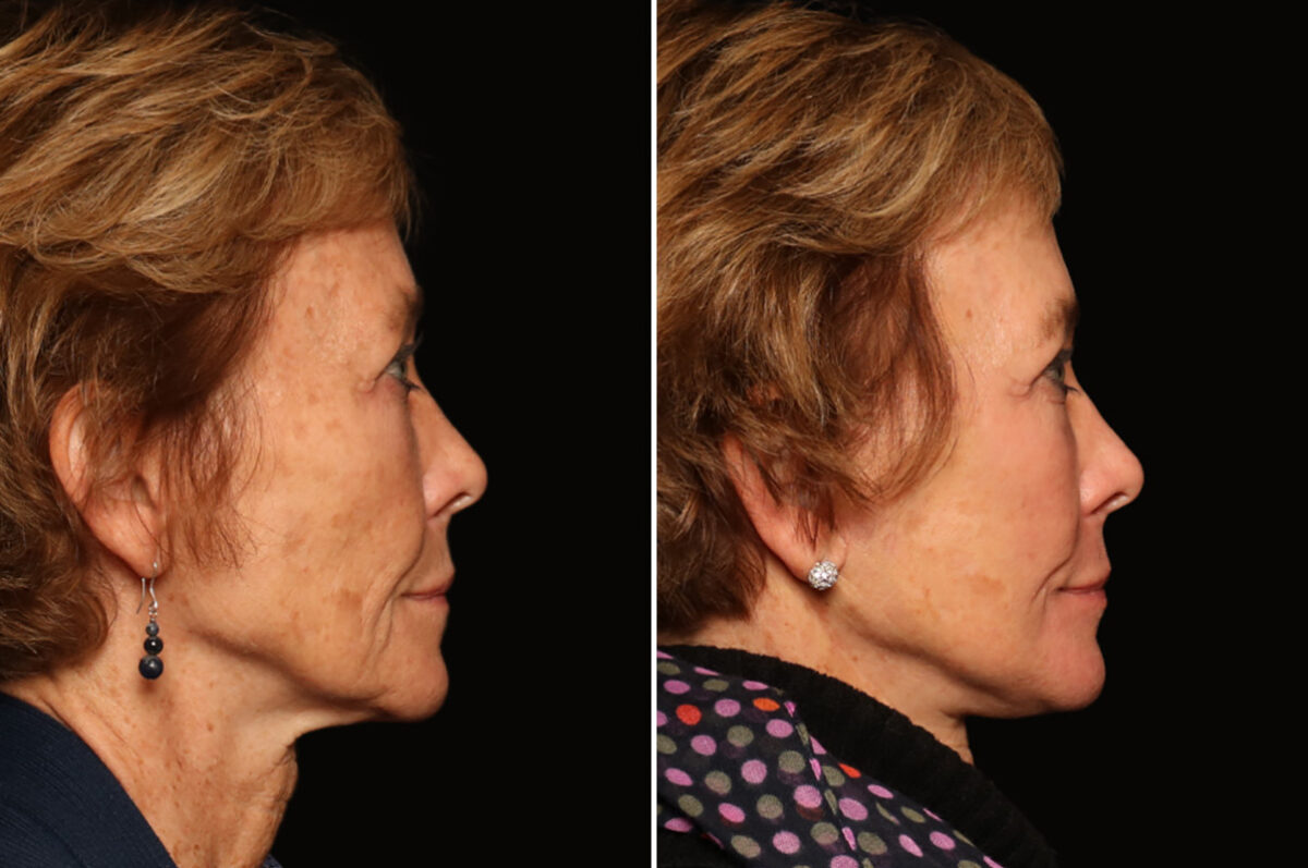 LuxeLift Before and After Photos in Cincinnati, OH, Patient 18470