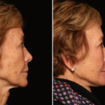 LuxeLift Before and After Photos in Cincinnati, OH, Patient 18470