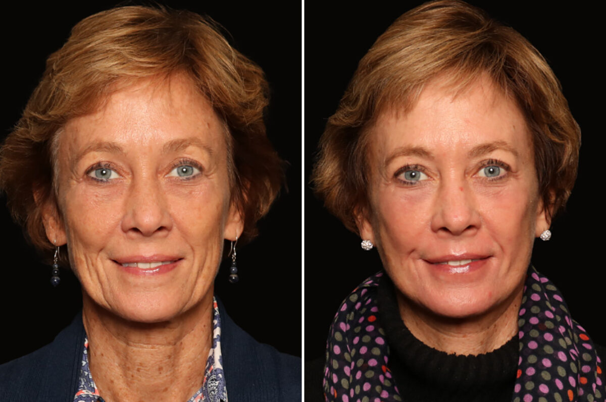 LuxeLift Before and After Photos in Cincinnati, OH, Patient 18470