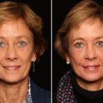 LuxeLift Before and After Photos in Cincinnati, OH, Patient 18470