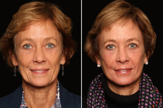 LuxeLift Before and After Photos in Cincinnati, OH, Patient 18470