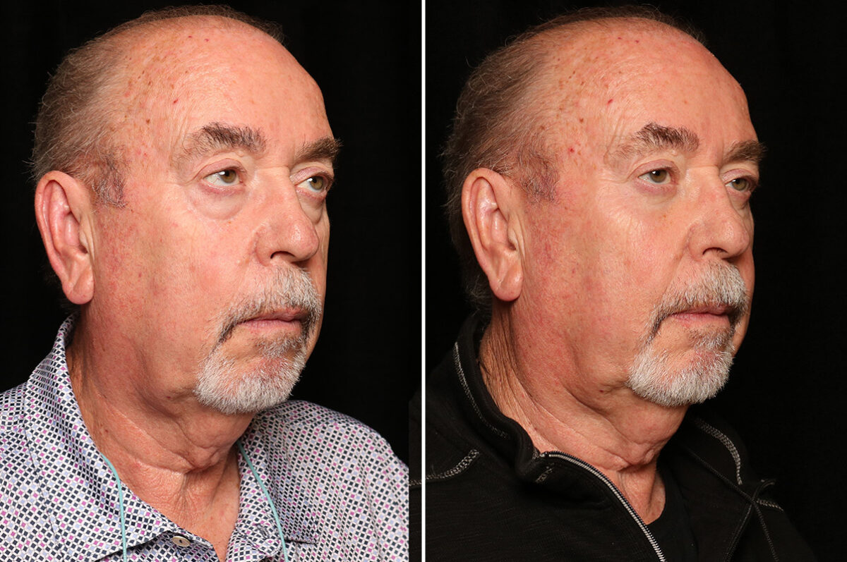 LuxeLift Before and After Photos in Cincinnati, OH, Patient 18809