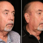 LuxeLift Before and After Photos in Cincinnati, OH, Patient 18809